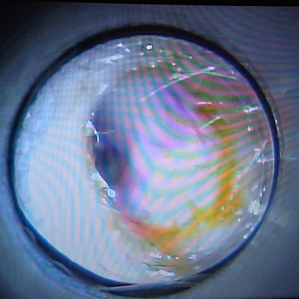 耳垢には２つのタイプがあるらしい